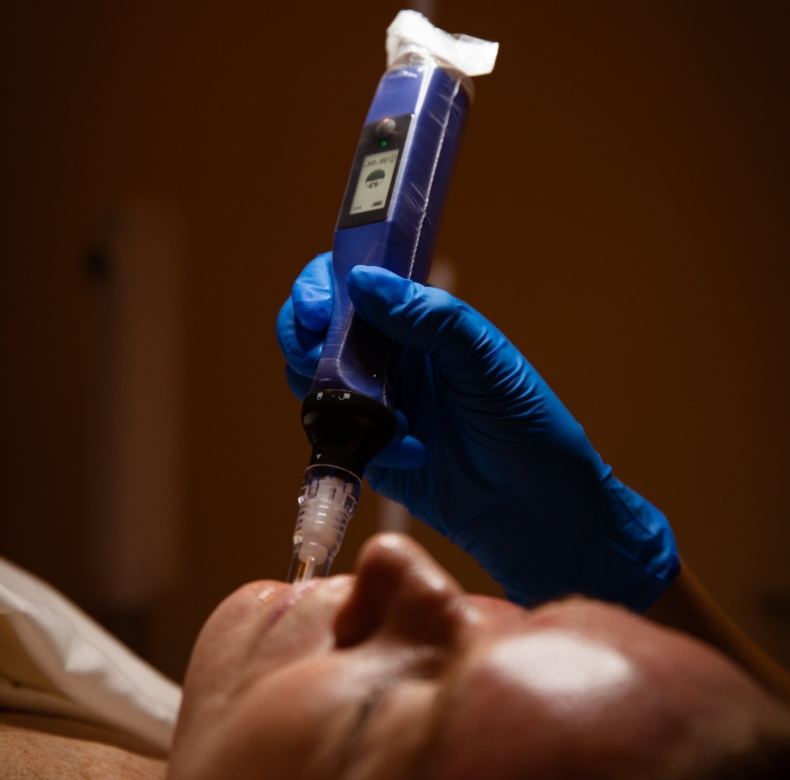 SkinPen micro-needling procedure at Eden Spa & Laser